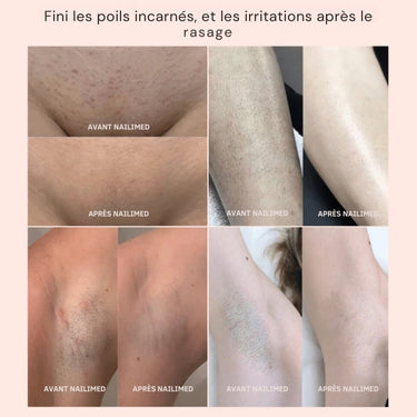 Nailimed™ Rasoir Électrique Féminin 2-en-1 – Indolore, Réutilisable, Anti-Poils Incarnés